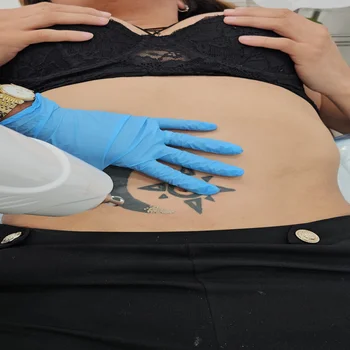 Laser Tattoo Removal North Miami 